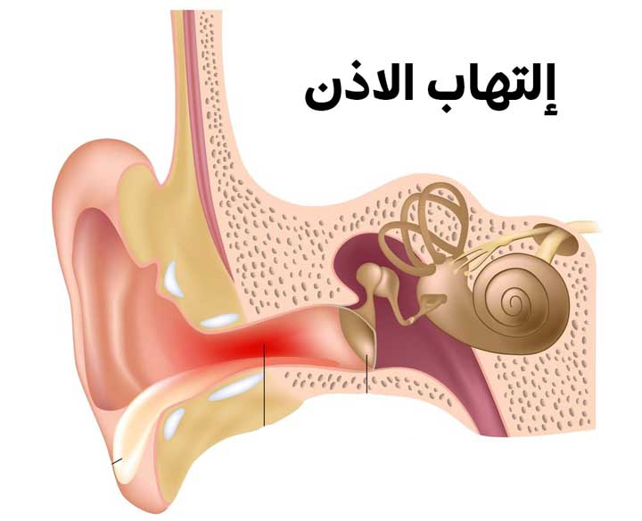 التهاب الاذن، اعراض التهاب الاذن