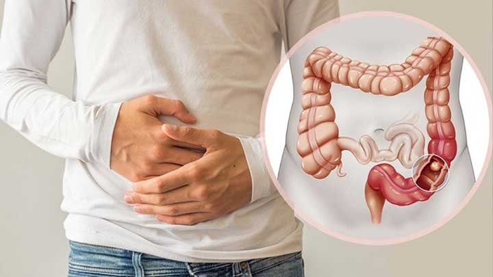 تعريف جرثومة المعدة والقولون، أعراض جرثومة المعدة والقولون