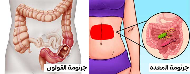 كيف تفرق بين جرثومة المعده والقولون؟ أعراض جرثومة المعدة والقولون