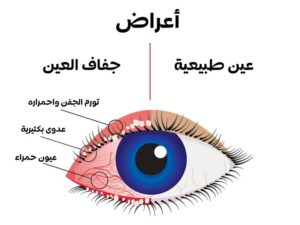 تعرف على أهم اسباب جفاف العين