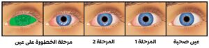 أفضل قطرة لعلاج جفاف العين، مراحل جفاف العين