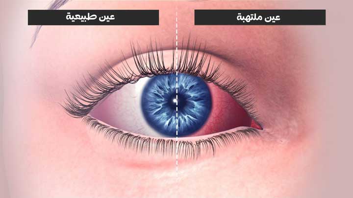 اعراض التهاب العين وافضل الطرق الممكنة في علاجه