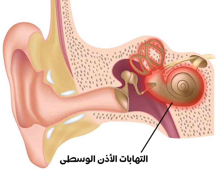 التهاب الاذن الوسطى، اسباب التهاب الاذن الوسطى