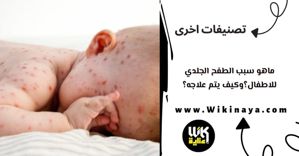 ماهو سبب الطفح الجلدي للاطفال؟وكيف يتم علاجه؟