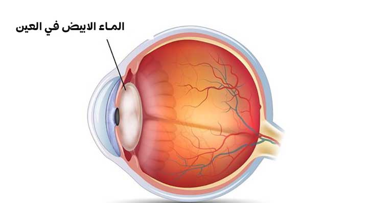 الماء الابيض في العين