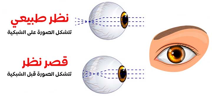 تعرف على قصر النظر أعراضه و مسبباته و طرق علاجه