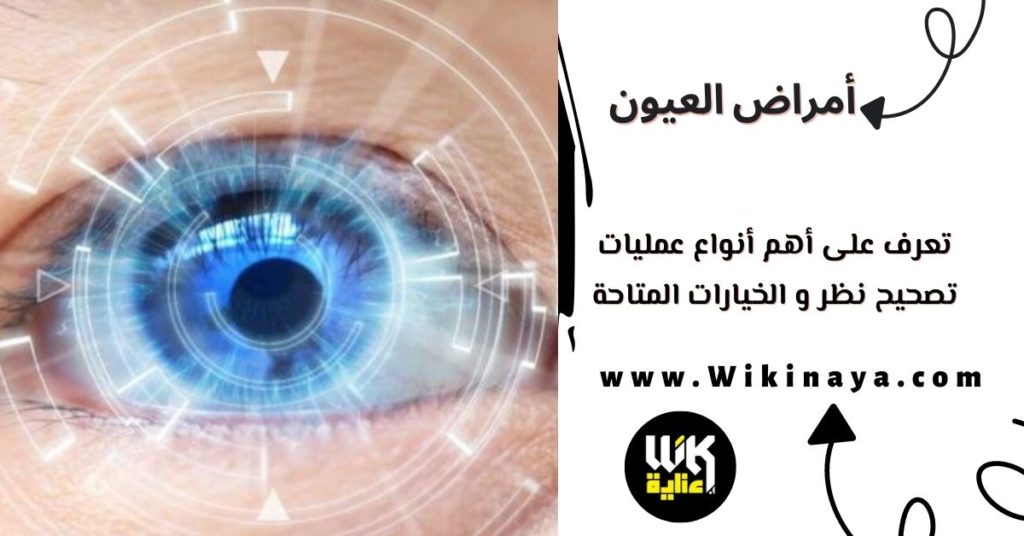 تعرف على أهم أنواع عمليات تصحيح نظر و الخيارات المتاحة