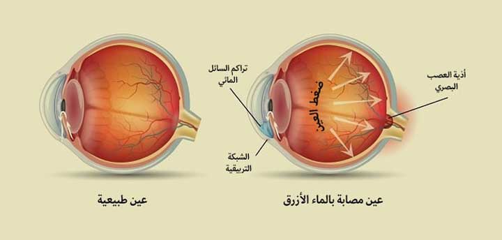 عملية الماء الابيض ماهي؟وكيف يتم إجراءها؟