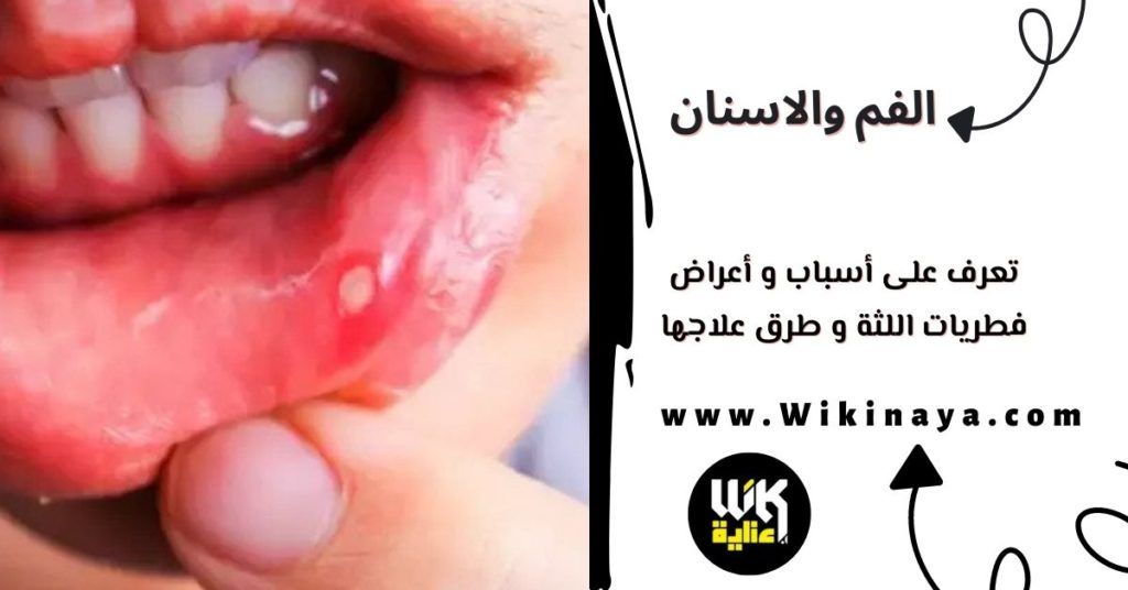 تعرف على أسباب و أعراض فطريات اللثة و طرق علاجها