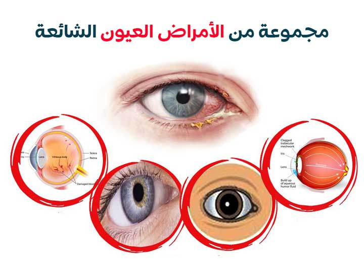 مجموعة من الأمراض العيون الشائعة