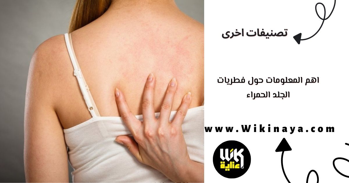 اهم المعلومات حول فطريات الجلد الحمراء