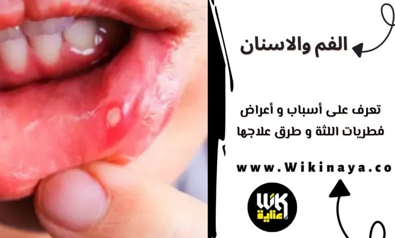 تعرف على أسباب و أعراض فطريات اللثة و طرق علاجها