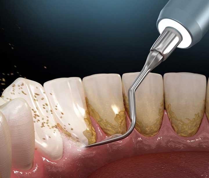 أسباب التهاب اللثة، علاج رائحة الفم