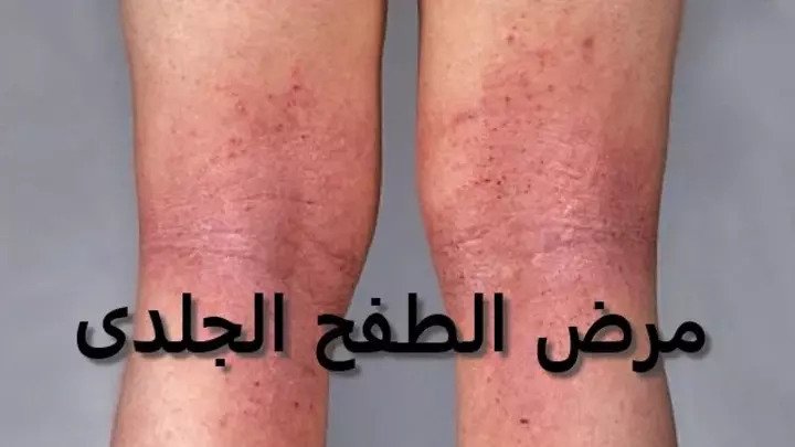 عرف على اسباب الطفح الجلدي ال6 و طرق علاجه و الوقاية منه