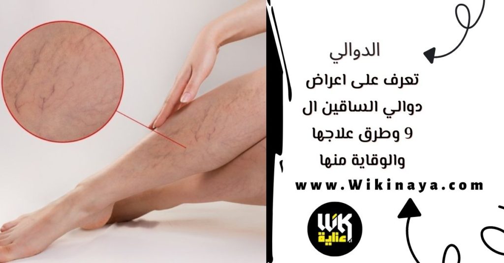 تعرف على اعراض دوالي الساقين ال 9 وطرق علاجها والوقاية منها