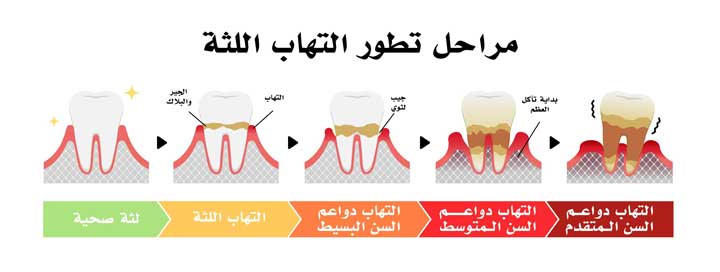 الأسباب وعوامل الخطر التهاب اللثه