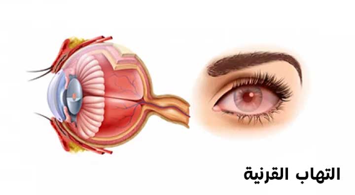 التهاب القرنية