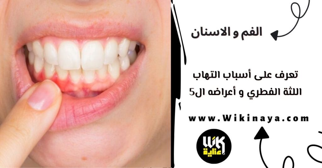 تعرف على أسباب التهاب اللثة الفطري و أعراضه ال5