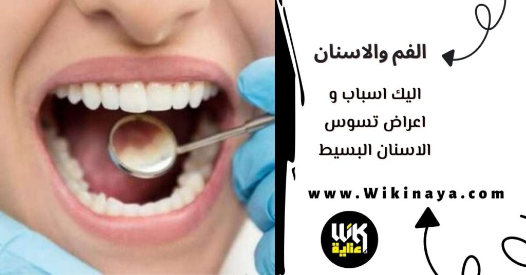 اليك اسباب و اعراض تسوس الاسنان البسيط