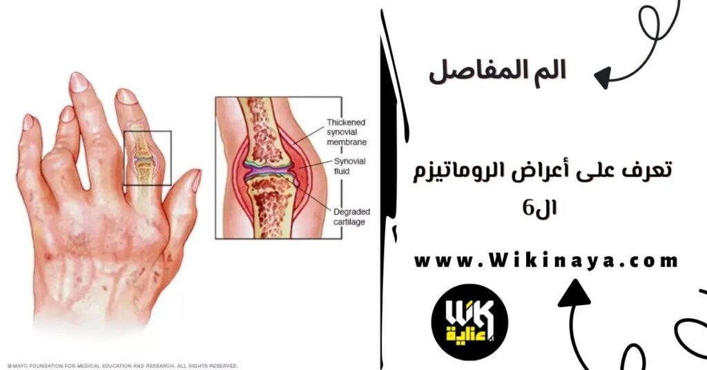 تعرف على أعراض الروماتيزم ال6