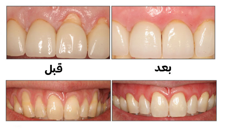 نتائج إستعمال معالج اللثة و غسول الفم المطهر Sparysils