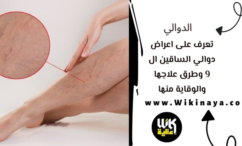 تعرف على اعراض دوالي الساقين ال 9 وطرق علاجها والوقاية منها