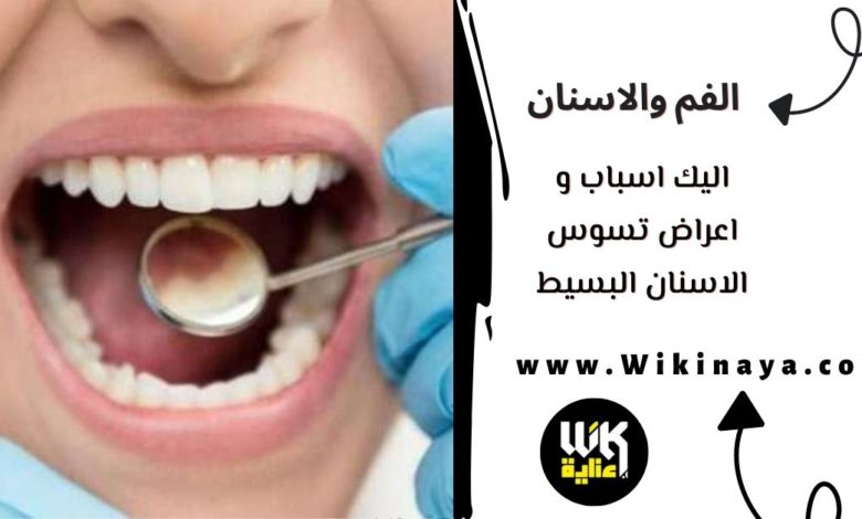 اليك اسباب و اعراض تسوس الاسنان البسيط