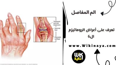 تعرف على أعراض الروماتيزم ال6