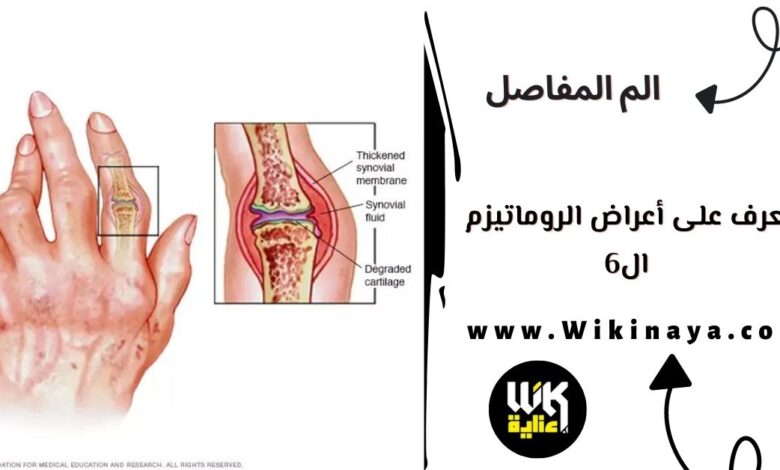 تعرف على أعراض الروماتيزم ال6