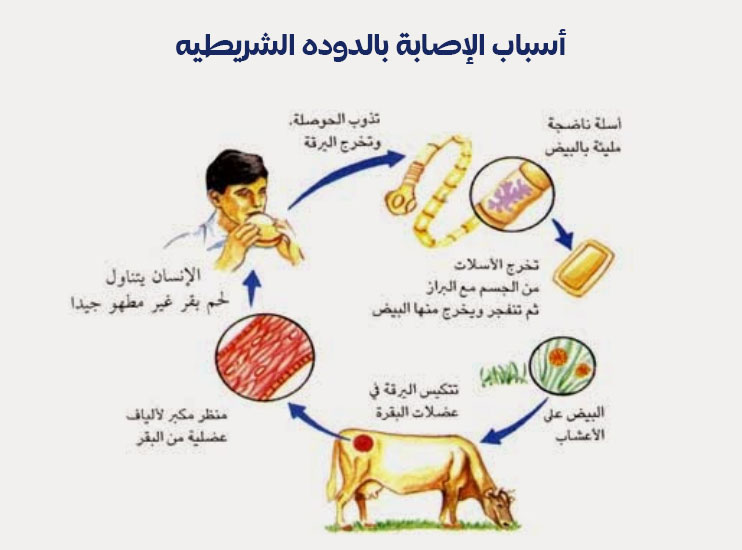 أسباب الإصابة بالدوده الشريطيه