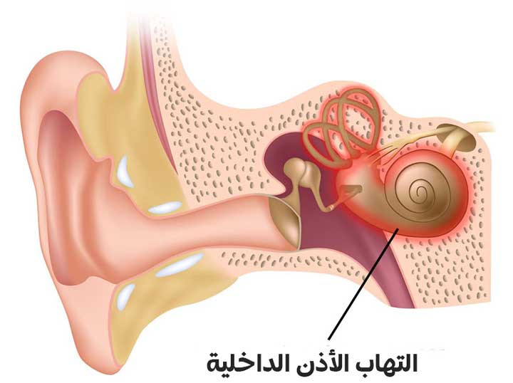 التهاب الأذن الداخلية