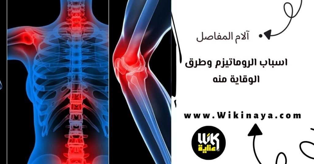 اسباب الروماتيزم وطرق الوقاية منه