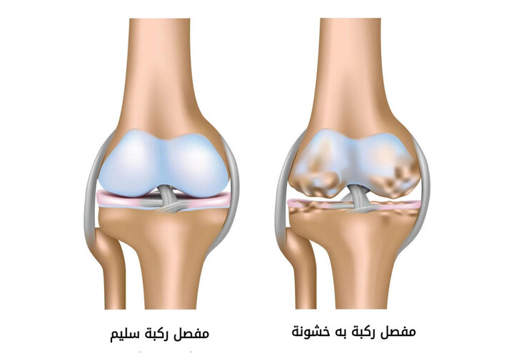 خشونة المفاصل أعراضها و أسبابها ال8 و كيفية علاجها