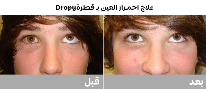 علاج احمرار العين بـ قطرة Dropy