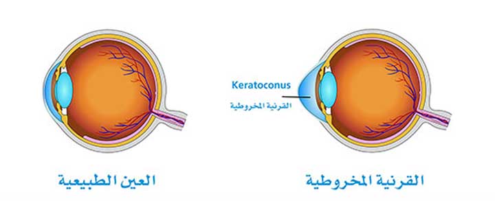 ما هي القرنية المخروطية؟