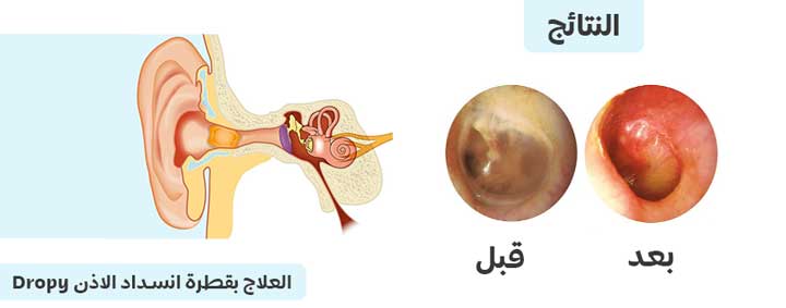 Dropy العلاج بقطرة انسداد الاذن