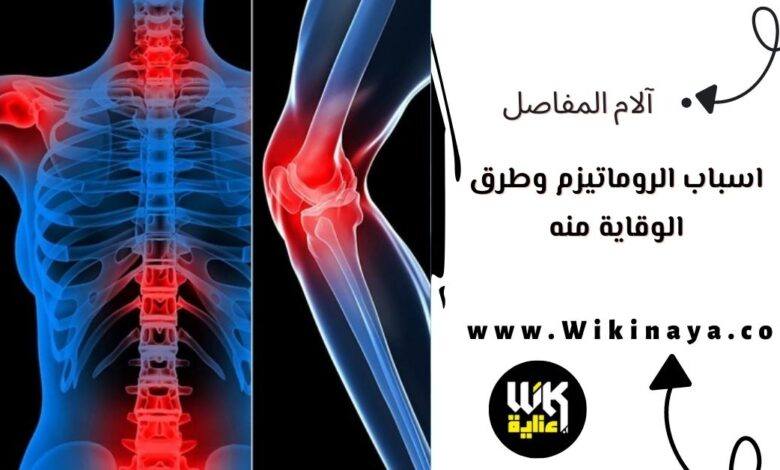 اسباب الروماتيزم وطرق الوقاية منه