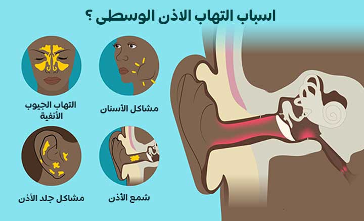 ما هي اسباب التهاب الاذن الوسطى ؟