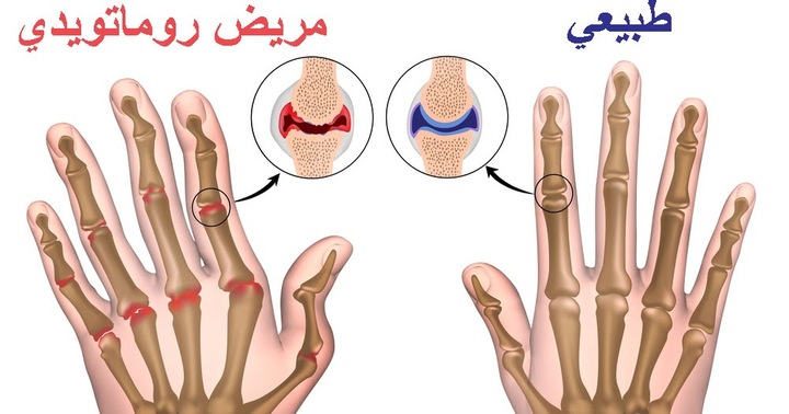 التهاب المفاصل الروماتويدي أعراضه و مسبباته و طرق علاجه