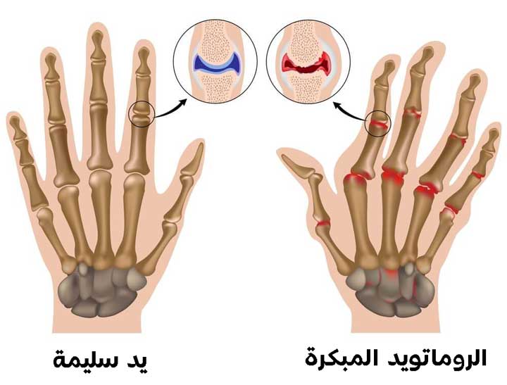 الروماتويد المبكرة