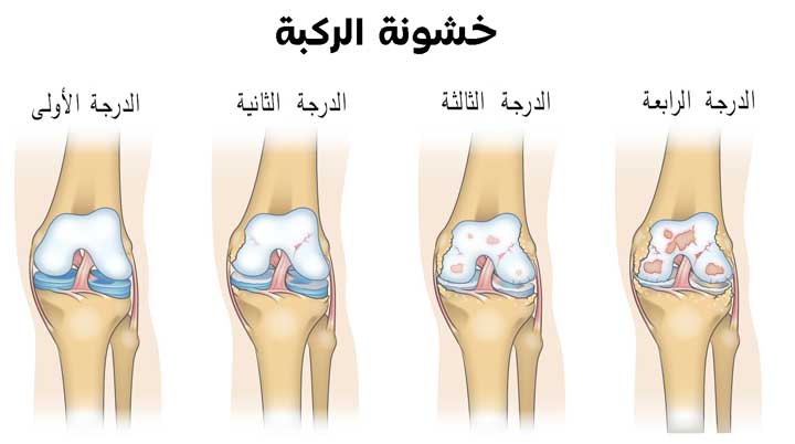 خشونة الركبة