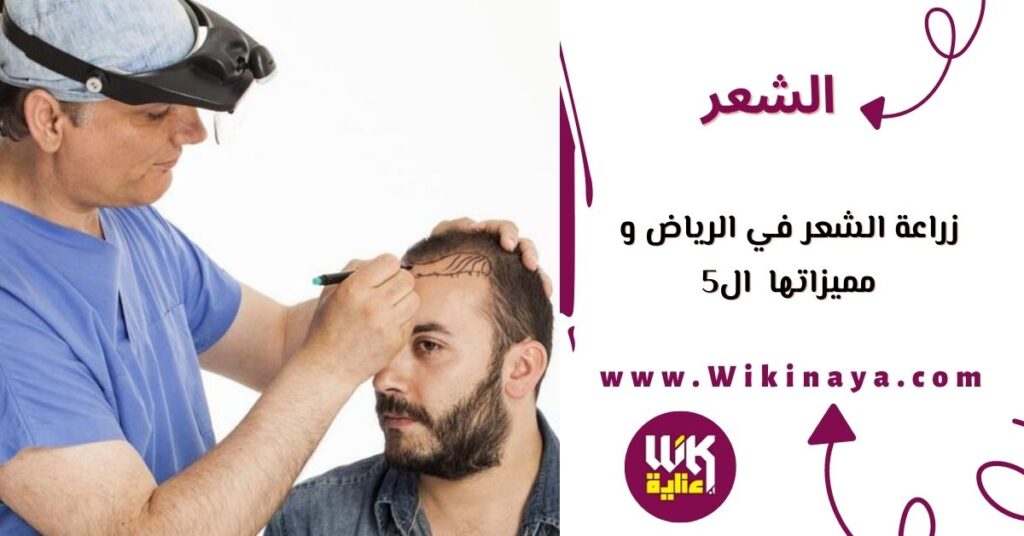 زراعة الشعر في الرياض و مميزاتها ال5