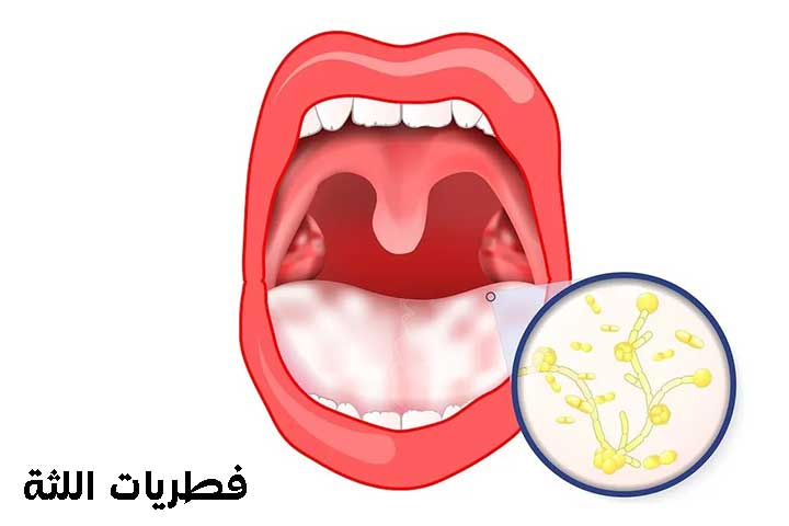 فطريات اللثة