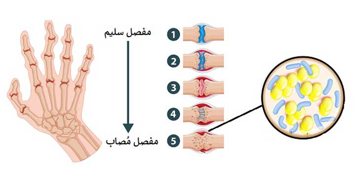 ما هي أنواع التهاب مفاصل اليد