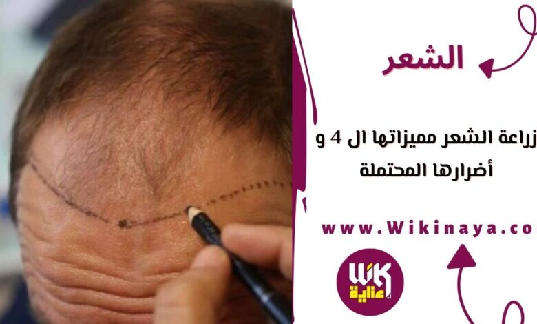 زراعة الشعر مميزاتها ال 4 و أضرارها المحتملة