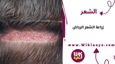 زراعة الشعر الرياض