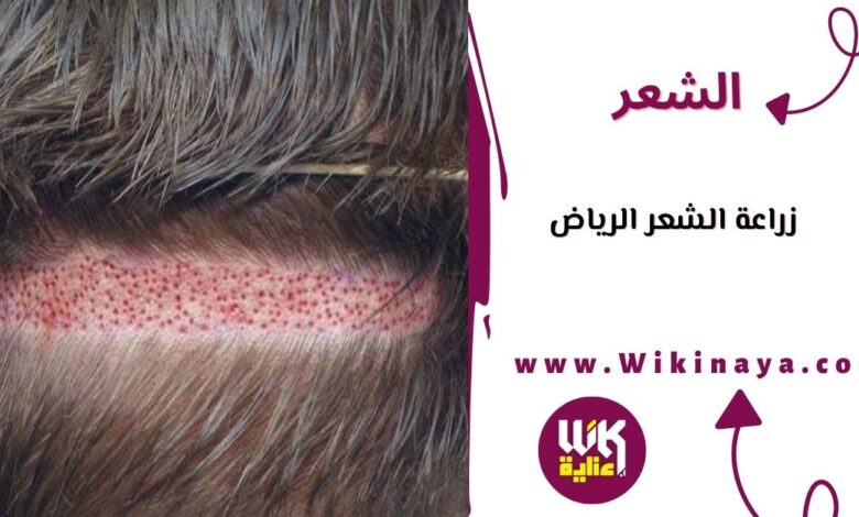 زراعة الشعر الرياض