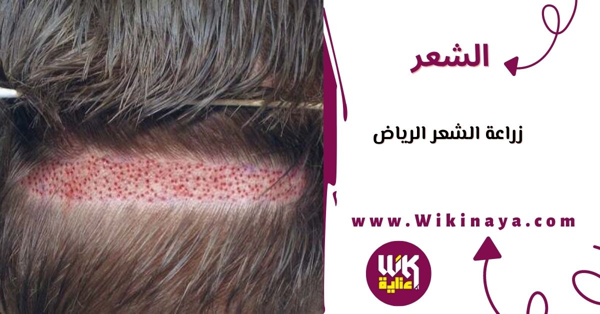 زراعة الشعر الرياض