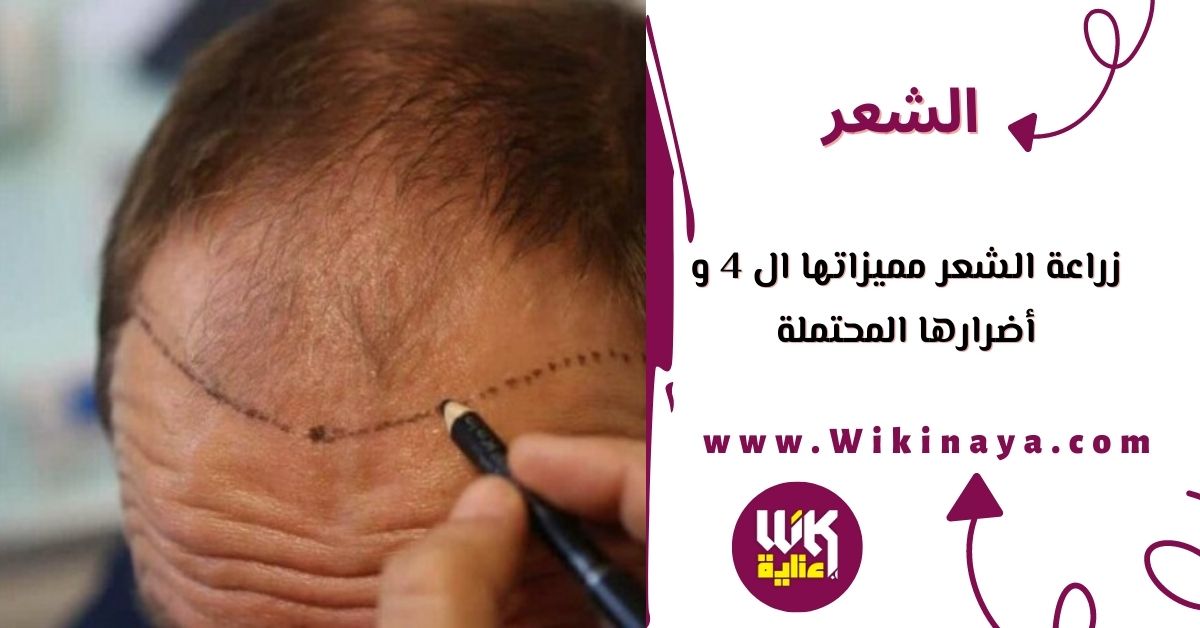 زراعة الشعر مميزاتها ال 4 و أضرارها المحتملة