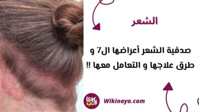 صدفية الشعر أعراضها ال7 و طرق علاجها و التعامل معها !!